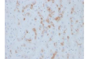 Formalin-fixed, paraffin-embedded human Hepatic Carcinoma stained with Cytochrome p450 Mouse Monoclonal Antibody (M12P4H2). (CYP2E1 Antikörper  (C-Term))
