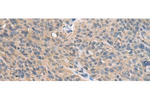 Immunohistochemistry of paraffin-embedded Human cervical cancer tissue using FAM19A4 Polyclonal Antibody at dilution of 1:55(x200) (FAM19A4 Antikörper)