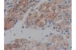 IHC-P analysis of Human Stomach cancer Tissue, with DAB staining.