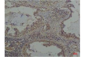 Immunohistochemistry (IHC) analysis of paraffin-embedded Human Lung Caricnoma using Phosphoserine Mouse mAb diluted at 1:200. (Phosphoserine Antikörper  (phosphorylated))