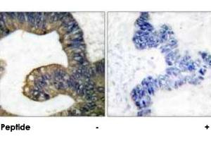 Immunohistochemical analysis of paraffin-embedded human colon carcinoma tissue using PLA2G4A polyclonal antibody . (PLA2G4A Antikörper)