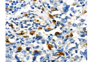 Phospho-STUB1/CHIP (Ser19) Antibody at 1/100 staining Human breast cancer by IHC-P. (STUB1 Antikörper  (pSer19))