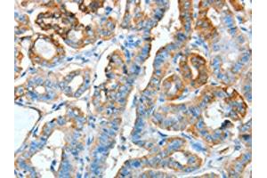 The image on the left is immunohistochemistry of paraffin-embedded Human thyroid cancer tissue using ABIN7128299(AGR3 Antibody) at dilution 1/15, on the right is treated with fusion protein. (AGR3 Antikörper)