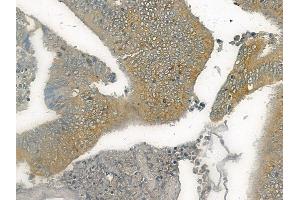 ABIN6265741 and ABIN6272531 at 1/100 staining human colon carcinoma by IHC-P.