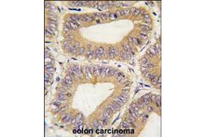 Formalin-fixed and paraffin-embedded human colon carcinoma tissue reacted with PHB2 Antibody , which was peroxidase-conjugated to the secondary antibody, followed by DAB staining. (Prohibitin 2 Antikörper  (C-Term))