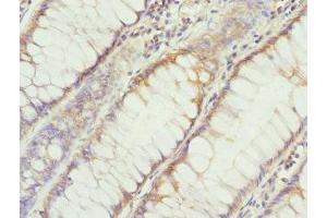 Immunohistochemistry of paraffin-embedded human colon cancer using ABIN7149608 at dilution of 1:100