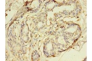 Immunohistochemistry of paraffin-embedded human breast cancer using ABIN7150765 at dilution of 1:100 (DUSP26 Antikörper  (AA 1-211))
