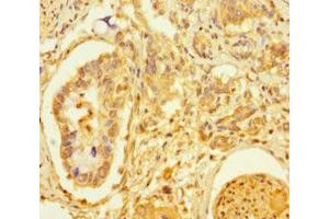 Immunohistochemistry of paraffin-embedded human pancreatic cancer using ABIN7172463 at dilution of 1:100 (TCF4 Antikörper  (AA 419-525))