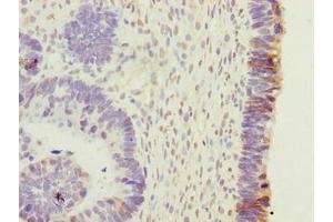 Immunohistochemistry of paraffin-embedded human ovarian cancer using ABIN7165317 at dilution of 1:100 (EFR3B Antikörper  (AA 1-298))