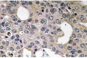 Immunohistochemistry (IHC) analyzes of CD124 / IL4R Antibody in paraffin-embedded human breast carcinoma tissue. (IL4 Receptor Antikörper)