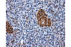 Immunohistochemical staining of paraffin-embedded Adenocarcinoma of colon tissue using anti-XRCC1mouse monoclonal antibody.