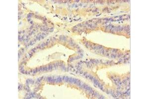 Immunohistochemistry of paraffin-embedded human endometrial cancer using ABIN7164935 at dilution of 1:100 (PSMF1 Antikörper  (AA 1-271))