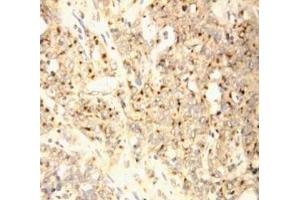 Anti-XAF1 antibody, IHC(P) IHC(P): Human Endometrial Carcinoma Tissue
