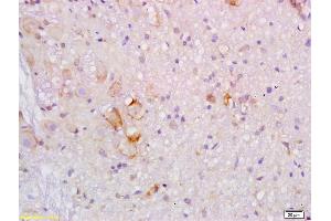 Formalin-fixed and paraffin embedded human colon carcinoma labeled with Rabbit Anti ApoB/Apolipoprotein B Polyclonal Antibody, Unconjugated (ABIN872950) at 1:200 followed by conjugation to the secondary antibody and DAB staining