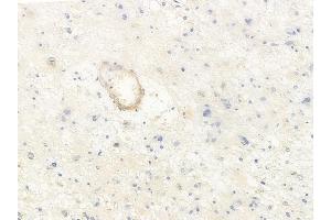 ABIN6265616 and ABIN6278288 at 1/100 staining human astrocytoma by IHC-P.