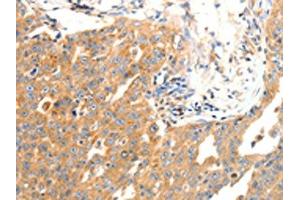 The image on the left is immunohistochemistry of paraffin-embedded Human ovarian cancer tissue using ABIN7190491(DOPEY1 Antibody) at dilution 1/25, on the right is treated with synthetic peptide. (DOPEY1 Antikörper)