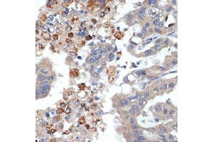 Immunohistochemistry of paraffin-embedded human liver cancer using PRSS2 Rabbit mAb (ABIN7269580) at dilution of 1:100 (40x lens). (PRSS2 Antikörper)