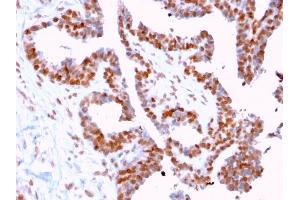 Formalin-fixed, paraffin-embedded human Prostate Carcinoma stained with CLEC9A Mouse Monoclonal Antibody (2H12/4). (DMC1 Antikörper)