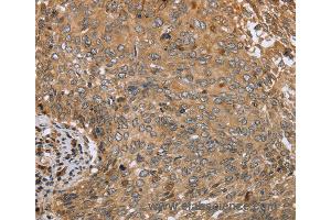 Immunohistochemistry of Human colon cancer using CLEC16A Polyclonal Antibody at dilution of 1:45