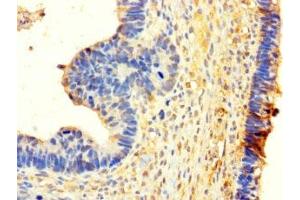Immunohistochemistry of paraffin-embedded human ovarian cancer using ABIN7155505 at dilution of 1:100 (WHSC1L1 Antikörper  (AA 1-645))