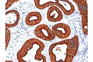 Formalin-fixed, paraffin-embedded human colon carcinoma stained with Cytokeratin 18 antibody (KRT18/834). (Cytokeratin 18 Antikörper)