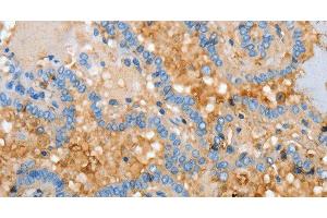 Immunohistochemistry of paraffin-embedded Human thyroid cancer using APOH Polyclonal Antibody at dilution of 1:30 (APOH Antikörper)