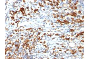Formalin-fixed, paraffin-embedded human Lymphoma stained with CD79a Mouse Monoclonal Antibody (IGA/764) (CD79a Antikörper)