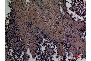 Immunohistochemistry (IHC) analysis of paraffin-embedded Human Lung Cancer, antibody was diluted at 1:100. (MCL-1 Antikörper  (Internal Region))