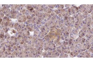 ABIN6273278 at 1/100 staining Human pancreas cancer tissue by IHC-P. (Oligophrenin 1 Antikörper)