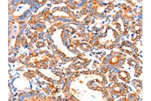 The image on the left is immunohistochemistry of paraffin-embedded Human thyroid cancer tissue using ABIN7192314(SEPT4 Antibody) at dilution 1/50, on the right is treated with synthetic peptide. (Septin 4 Antikörper)