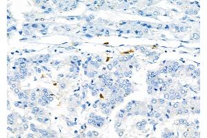 ABIN6264974 and ABIN6276799 at 1/100 staining Human liver cancer by IHC-P.