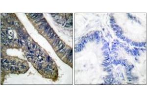 Immunohistochemistry analysis of paraffin-embedded human colon carcinoma, using c-PLA2 (Phospho-Ser505) Antibody. (C-PLA2 (AA 471-520), (pSer505) Antikörper)