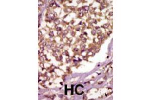 Formalin-fixed and paraffin-embedded human hepatocellular carcinoma tissue reacted with BMX polyclonal antibody  , which was peroxidase-conjugated to the secondary antibody, followed by AEC staining. (BMX Antikörper  (Internal Region))