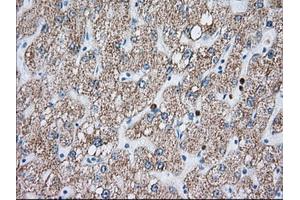 Immunohistochemical staining of paraffin-embedded Carcinoma of Human liver tissue using anti-MTRF1L mouse monoclonal antibody. (MTRF1L Antikörper)