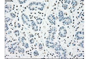 Immunohistochemical staining of paraffin-embedded breast tissue using anti-CHEK2 mouse monoclonal antibody. (CHEK2 Antikörper)