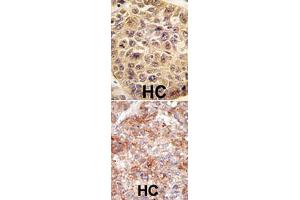 (TOP) Formalin-fixed and paraffin-embedded human hepatocellular carcinoma reacted with UBB polyclonal antibody  , which was peroxidase-conjugated to the secondary antibody, followed by DAB staining. (Ubiquitin B Antikörper  (N-Term))