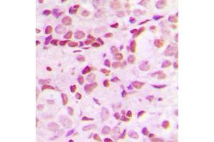 Immunohistochemical analysis of SP1 (pT453) staining in human breast cancer formalin fixed paraffin embedded tissue section. (SP1 Antikörper  (pSer453))