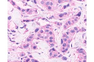 Anti-CELSR2 antibody IHC of human Breast, Carcinoma.