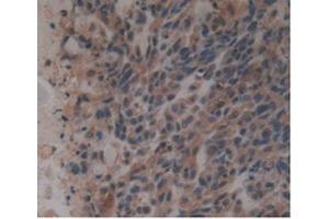 Detection of GDF3 in Human Lung Cancer Tissue using Monoclonal Antibody to Growth Differentiation Factor 3 (GDF3) (GDF3 Antikörper  (AA 251-364))
