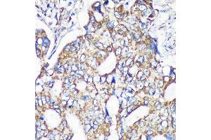 Immunohistochemistry of paraffin-embedded Human colon carcinoma using MRPS35 Rabbit pAb (ABIN7268587) at dilution of 1:100 (40x lens). (MRPS35 Antikörper  (AA 1-323))