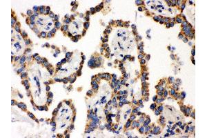 Anti- WASP Picoband antibody, IHC(P) IHC(P): Human Lung Cancer Tissue (WASP Antikörper  (C-Term))
