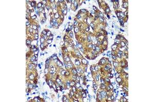 Immunohistochemistry of paraffin-embedded Human liver cancer using [KO Validated] NSDHL Rabbit pAb (ABIN7268794) at dilution of 1:100 (40x lens). (NSDHL Antikörper  (AA 1-240))