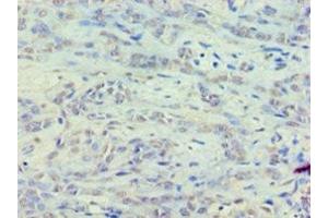Immunohistochemistry of paraffin-embedded human breast cancer using ABIN7152122 at dilution of 1:100