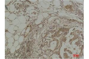 Immunohistochemical analysis of paraffin-embedded Human Breast Carcinoma using Pan Methylated Lysine Monoclonal Antibody. (Methylated Lysine Antikörper)