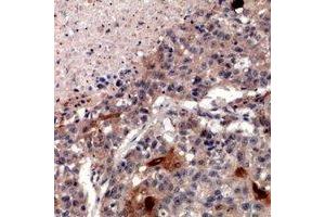 Immunohistochemical analysis of ZNT2 staining in human lung cancer formalin fixed paraffin embedded tissue section. (SLC30A2 Antikörper)
