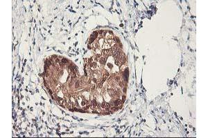 Immunohistochemical staining of paraffin-embedded Adenocarcinoma of Human breast tissue using anti-RBBP7 mouse monoclonal antibody. (RBBP7 Antikörper)