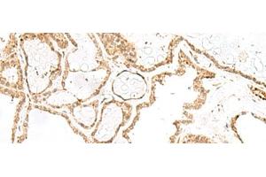 Immunohistochemistry of paraffin-embedded Human thyroid cancer tissue using RPP14 Polyclonal Antibody at dilution of 1:60(x200) (RPP14 Antikörper)