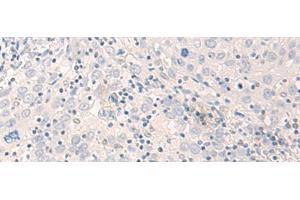 Immunohistochemistry of paraffin-embedded Human cervical cancer tissue using THOP1 Polyclonal Antibody at dilution of 1:35(x200) (Thimet Oligopeptidase 1 Antikörper)