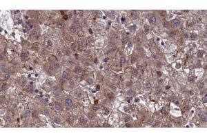 ABIN6273963 at 1/100 staining Human liver cancer tissue by IHC-P. (OR7E24 Antikörper)
