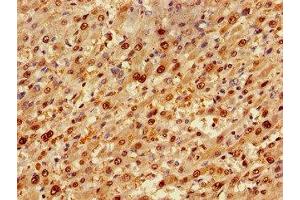 Immunohistochemistry of paraffin-embedded human liver cancer using ABIN7173917 at dilution of 1:100 (TP53INP1 Antikörper  (AA 138-205))